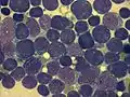 bone marrow smear (large magnification) from a person with acute lymphoblastic leukemia