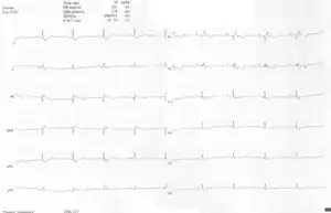 A 10-lead ECG of a woman with Ebstein's anomaly: The ECG shows signs of right atrial enlargement, best seen in V1. Other P waves are broad and tall, these are termed "Himalayan" P waves. Also, a right bundle-branch block pattern and a first-degree atrioventricular block (prolonged PR-interval) due to intra-atrial conduction delay are seen. No evidence of a Kent-bundle is seen in this patient. The T wave inversion in V1-4 and a marked Q wave in III occur; these changes are characteristic for Ebstein's anomaly and do not reflect ischemic ECG changes in this patient.