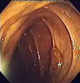 Polyp is identified.