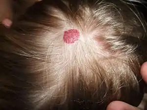 Hemangioma on the scalp of a 2-year-old child, in the "rest stage"