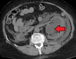 Left sided hydronephrosis in a person with an atrophic right kidney. Stent is also present (image below).