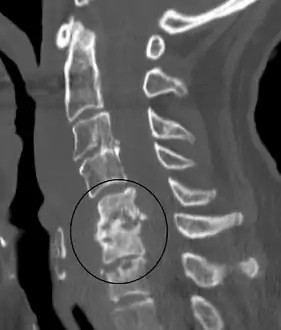 An infected disc at the level of C5 C6 causing neurological symptoms