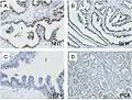 Microscopic examination of different types of prostate tissues (stained with immuno­histochemical techniques): A. Normal (non-neoplastic) prostatic tissue (NNT). B. Benign prostatic hyperplasia. C. High-grade prostatic intraepithelial neoplasia. D. Prostatic adenocarcinoma (PCA).