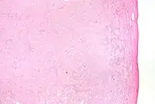 Low magnification micrograph of a thecoma. H&E stain.