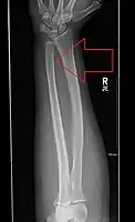 Undisplaced isolated ulna fracture