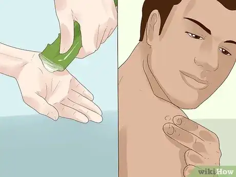 صورة عنوانها Get Rid of Skin Tags Step 10