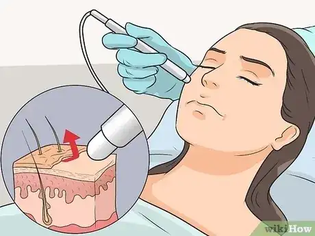 صورة عنوانها Get Rid of Red Acne Marks Step 14