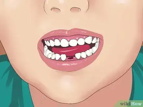 صورة عنوانها Stop the Bleeding After You Pull out a Loose Tooth Step 2