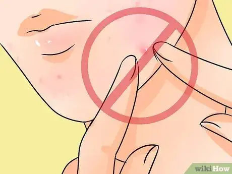 صورة عنوانها Get Rid of Acne Naturally Step 30