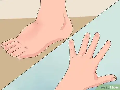 صورة عنوانها Reduce Edema Naturally Step 1