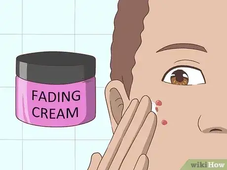 صورة عنوانها Get Rid of Acne Cysts Fast Step 19