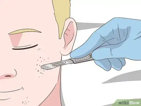 صورة عنوانها Get Rid of Acne Cysts Fast Step 23