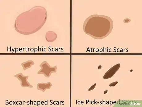 صورة عنوانها Get Rid of Acne Cysts Fast Step 17