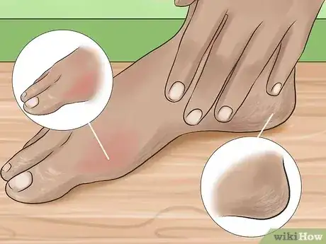 صورة عنوانها Care for Rough, Dry Feet Step 12