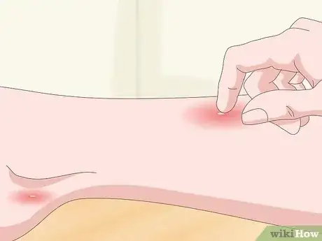 صورة عنوانها Detect Flea Bites Step 1