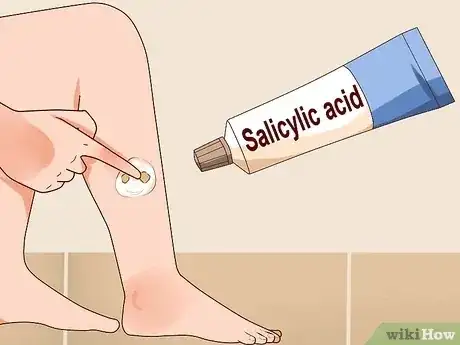 صورة عنوانها Remove Warts Naturally Using Garlic Step 13