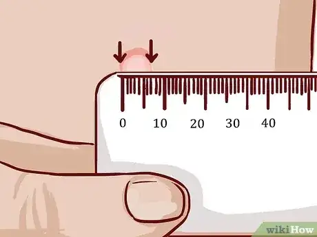 صورة عنوانها Read a Tuberculosis Skin Test Step 5