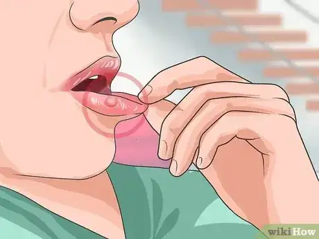 صورة عنوانها Recognize HIV Symptoms Step 5