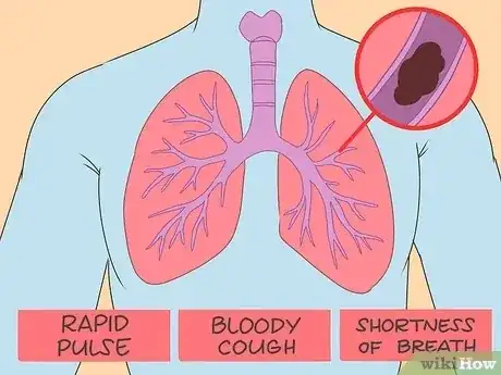 صورة عنوانها Dissolve Blood Clots Step 6