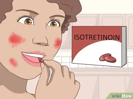 صورة عنوانها Get Rid of Acne Cysts Fast Step 5