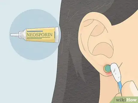 Image titled Clean Your Ear Piercing Step 5