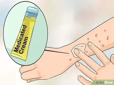 Gambar berjudul Identify an HIV Rash Step 9