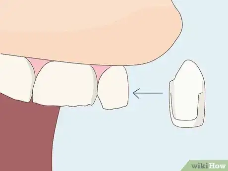 Gambar berjudul Fix an Uneven Smile Step 18