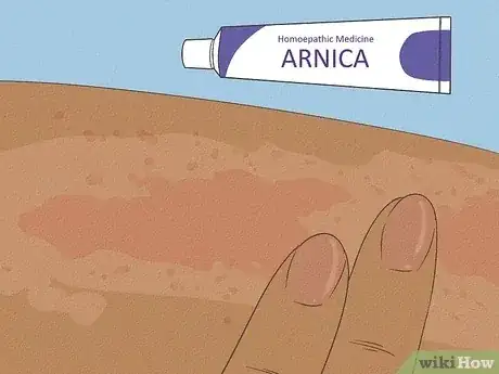 Gambar berjudul Get Rid of a Rash Step 6