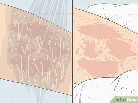 Gambar berjudul Get Rid of a Rash Step 2