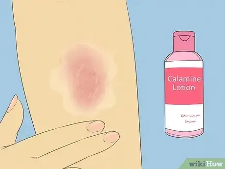 Gambar berjudul Get Rid of a Rash Step 9