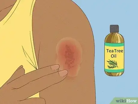 Gambar berjudul Get Rid of a Rash Step 7