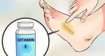 Mengangkat Jahitan Luka