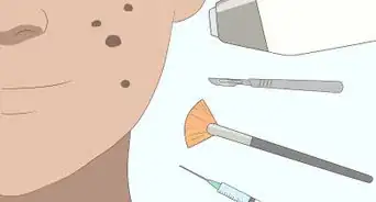 Menghilangkan Noda Hitam Bekas Jerawat