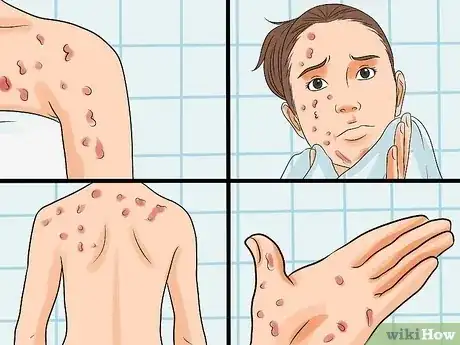 Gambar berjudul Identify an HIV Rash Step 2