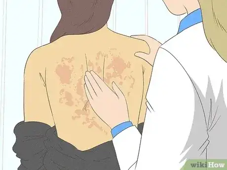 Gambar berjudul Get Rid of a Rash Step 13