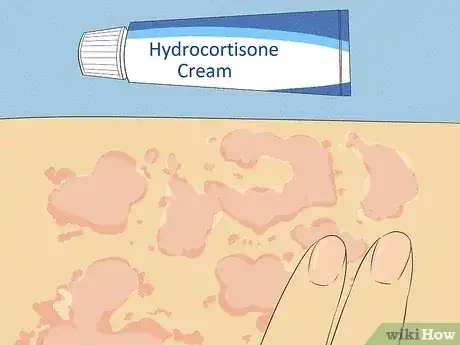 Gambar berjudul Get Rid of a Rash Step 11