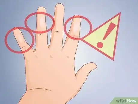 Gambar berjudul Recognize Frostbite Step 5