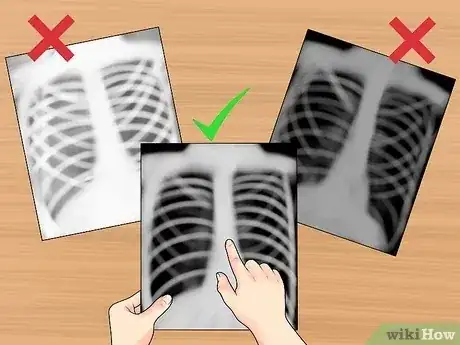 Gambar berjudul Read a Chest X Ray Step 5