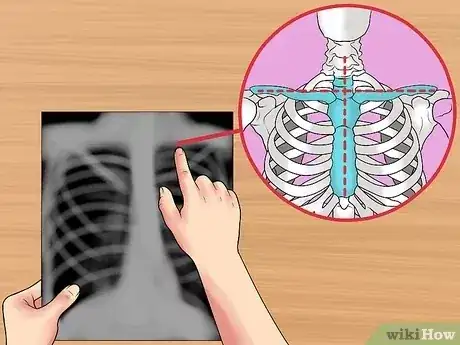 Gambar berjudul Read a Chest X Ray Step 6