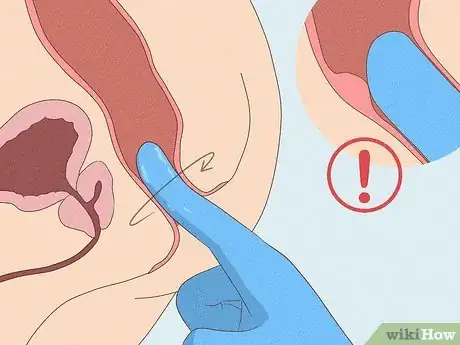 Imagem intitulada Check Your Prostate Step 10