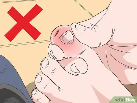 Imagem intitulada Remove a Deep Splinter Step 10
