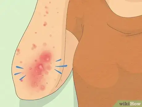 Imagem intitulada Recognize Scabies Rash Step 3