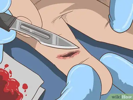 Imagem intitulada Remove a Deep Splinter Step 16