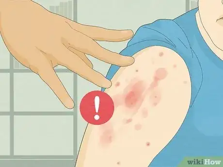 Imagem intitulada Recognize Scabies Rash Step 13