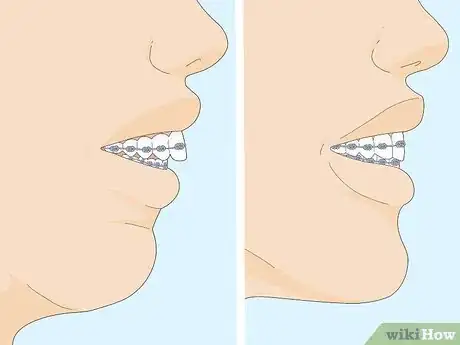 Imagem intitulada Fix an Overbite Step 8