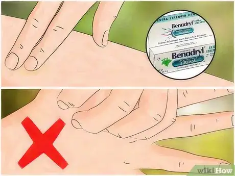 Imagem intitulada Identify Insect Bites Step 10