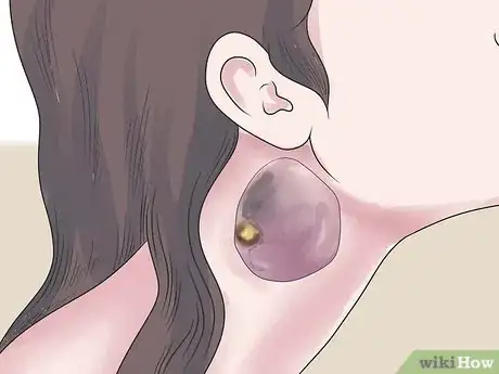 Imagem intitulada Treat an Infected Sebaceous Cyst Step 18