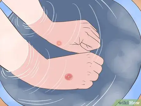 Imagem intitulada Get Rid of an Abscess Step 3