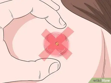 Imagem intitulada Get Rid of an Abscess Step 1