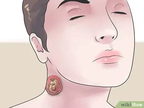 Imagem intitulada Treat an Infected Sebaceous Cyst Step 20